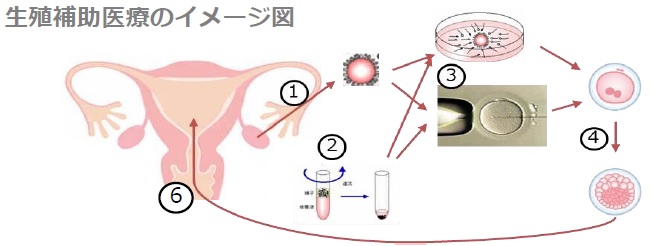 体外顕微授精のイメージ