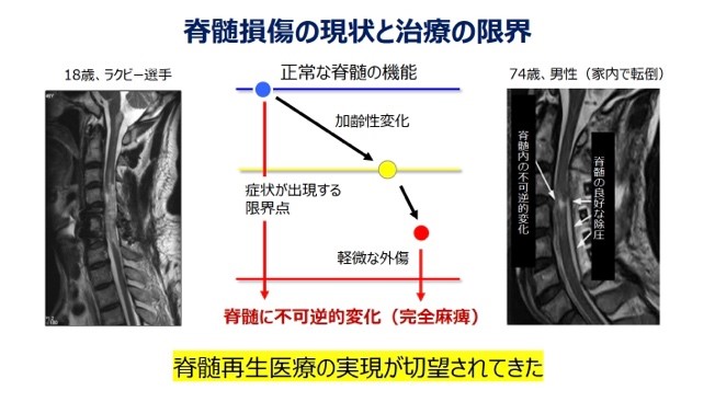 脊髄損傷の現状と治療の限界