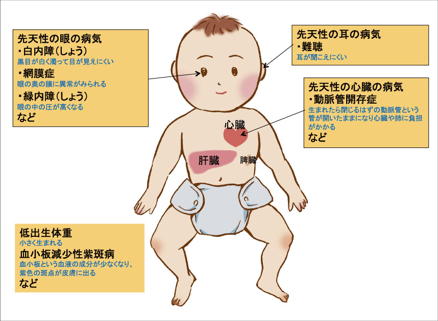 先天性風しん症候群の児に見られる主な症状