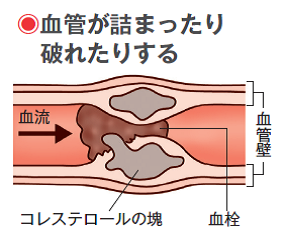 高血圧は、重大な病気のもと